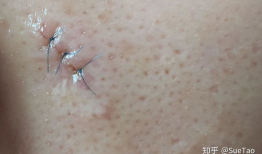痣切除手术视频全过程,专业操作与术后护理详解